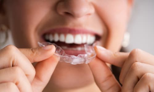 Save on clear aligners at 208 Dental