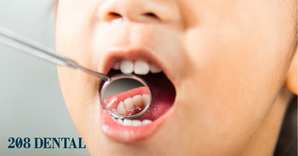 How Important Is It To Fix Baby Teeth?