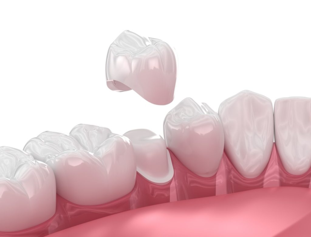Dental crowns near me